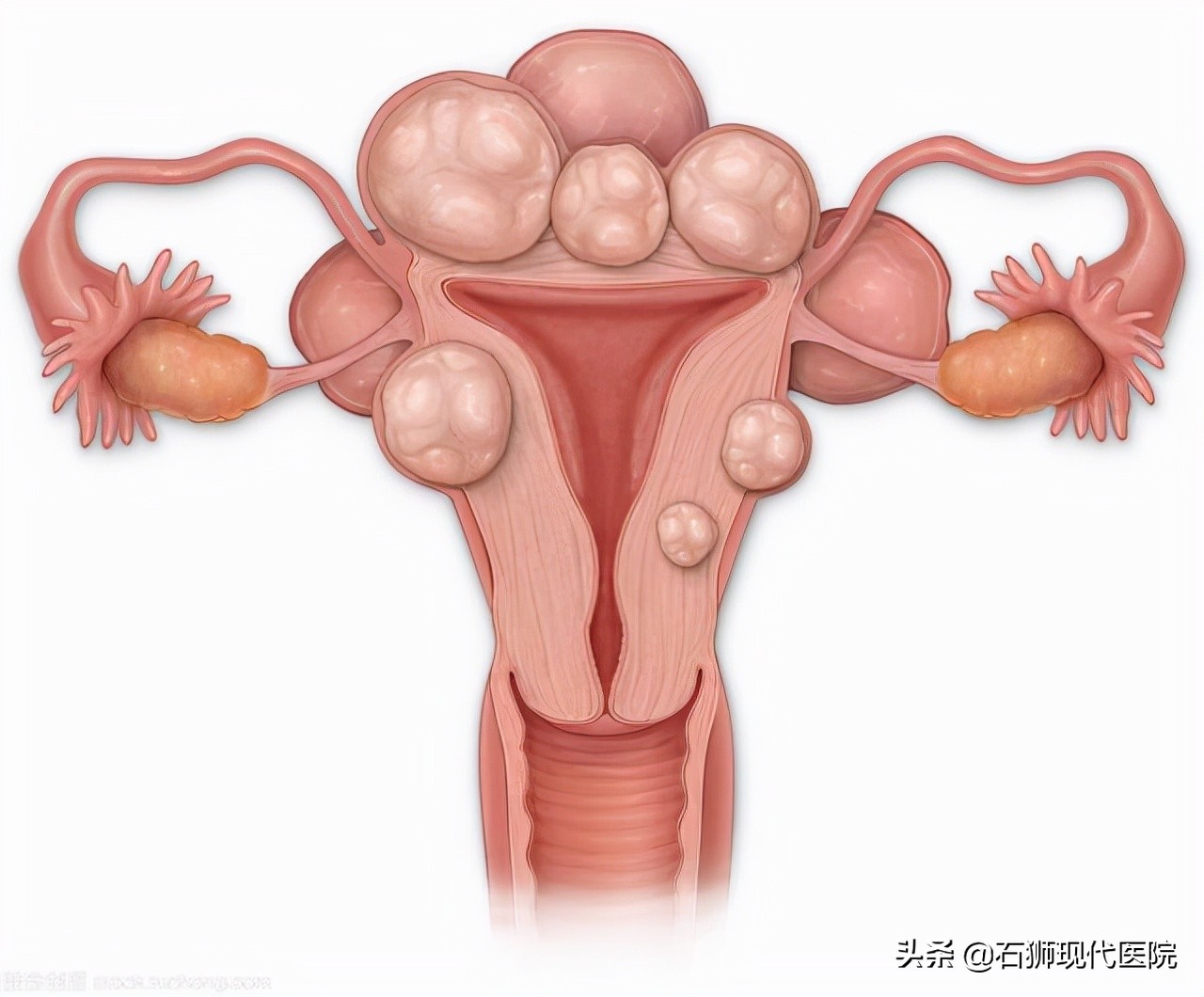 宫颈囊肿、宫颈肥大、宫颈息肉，谁离宫颈癌最近？