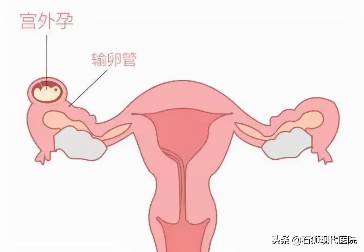 巧于伪装、随时引爆、危及生命！你想不到的「宫外孕」