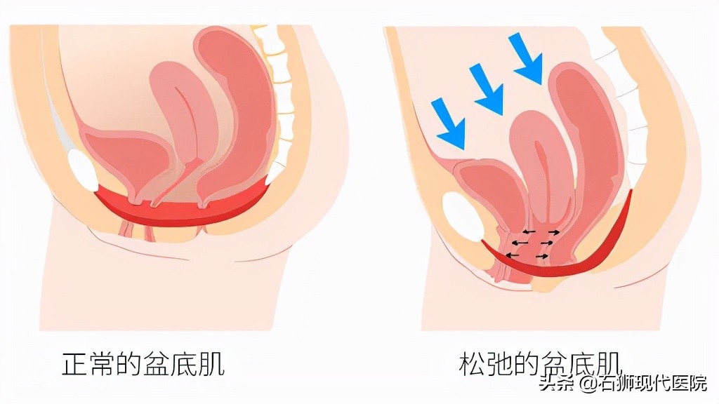 生娃后，阴道松弛、漏尿、妇科病？如何改善，就要做好这件事