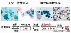 想预防宫颈癌，光打HPV疫苗不够！21岁开