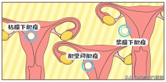 大家好，我是一枚10岁的子宫肌瘤