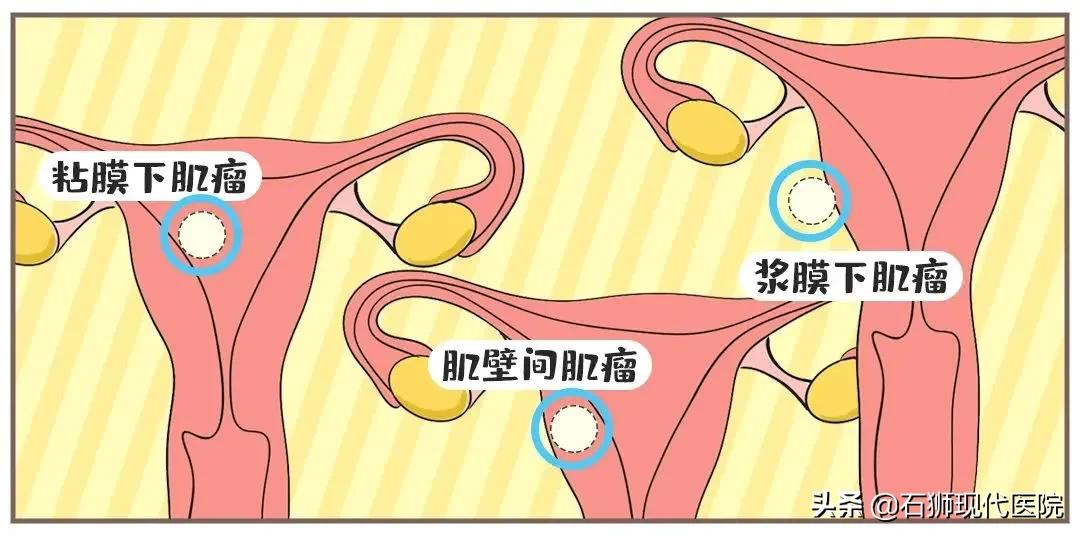 大家好，我是一枚10岁的子宫肌瘤