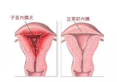 @女生们请注意,子宫内膜炎,忽视它的后