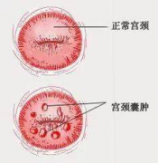 宫颈的“青春痘”—宫颈囊肿，你知道