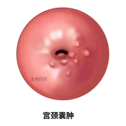 宫颈囊肿到底是什么?