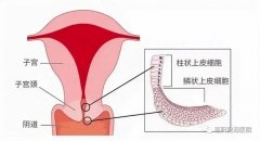 “宫颈糜烂”不是病，竟还有人不知道