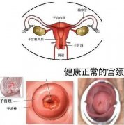 你知道宫颈糜烂是什么吗？知道怎么预