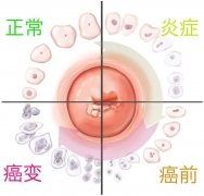 女性最常见妇科疾患，你需要了解
