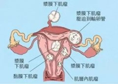 子宫肌瘤，不容忽视的女性常见病