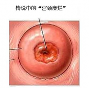 宫颈糜烂：1度→2度→3度→HPV阳性→等