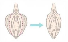 什么是阴唇整形手术？