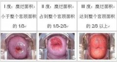 宫颈糜烂不是病，病变起来要你命，千