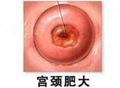 宫颈肥大是咋回事，需要治疗吗？