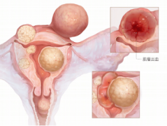 子宫肌瘤，只能选择手术治疗吗？